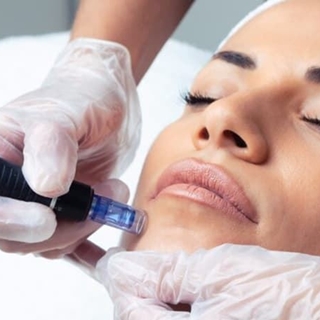 Regalos Navidad Facial Rejuvenecimiento Exosomas con Dermapen - Imagen 1